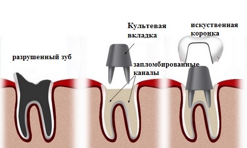 Использование культевой вкладки при установке коронок
